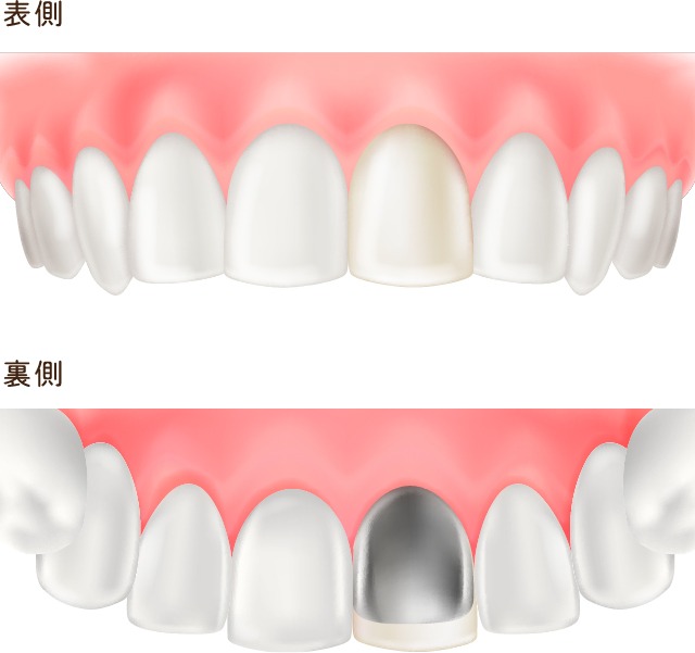 硬質レジン前装冠（前歯のみ）